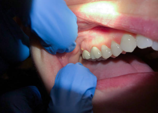 Best Emergency Wisdom Teeth Removal in St Joseph, MO